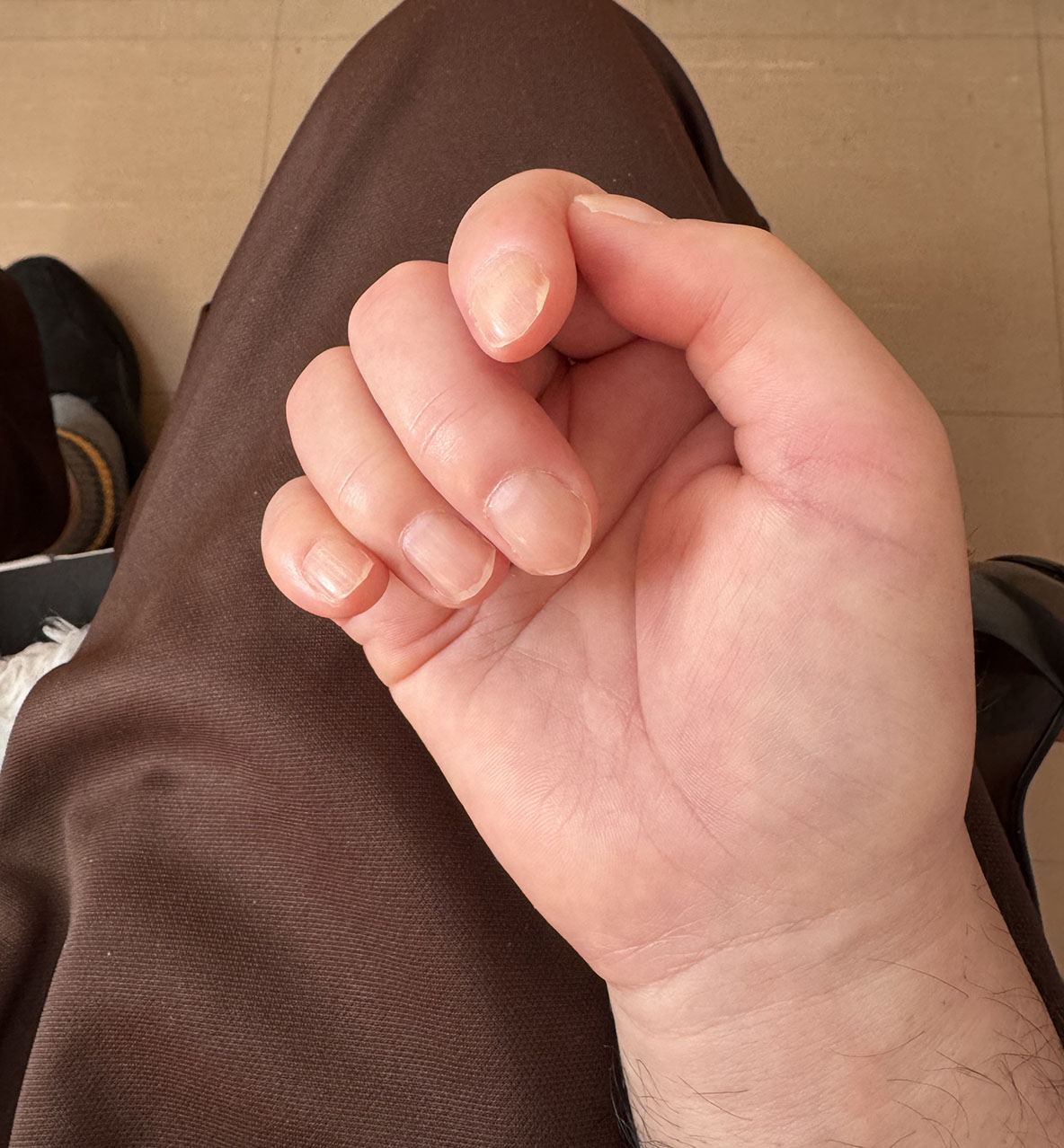 脳梗塞の後遺症で指が硬くなり、グーの形のままの右手