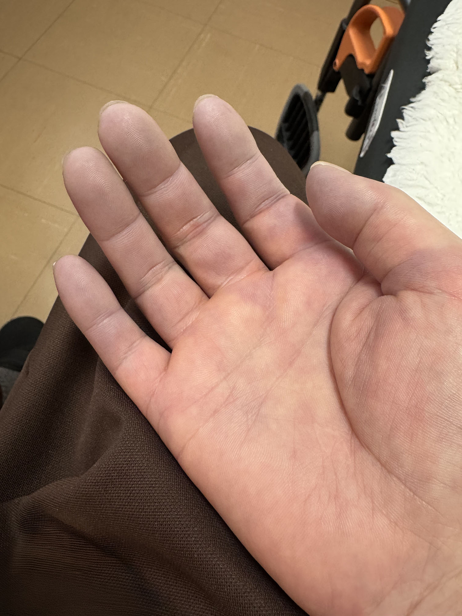 混合性結合組織病によるレイノー症状で紫色に変化した指の写真