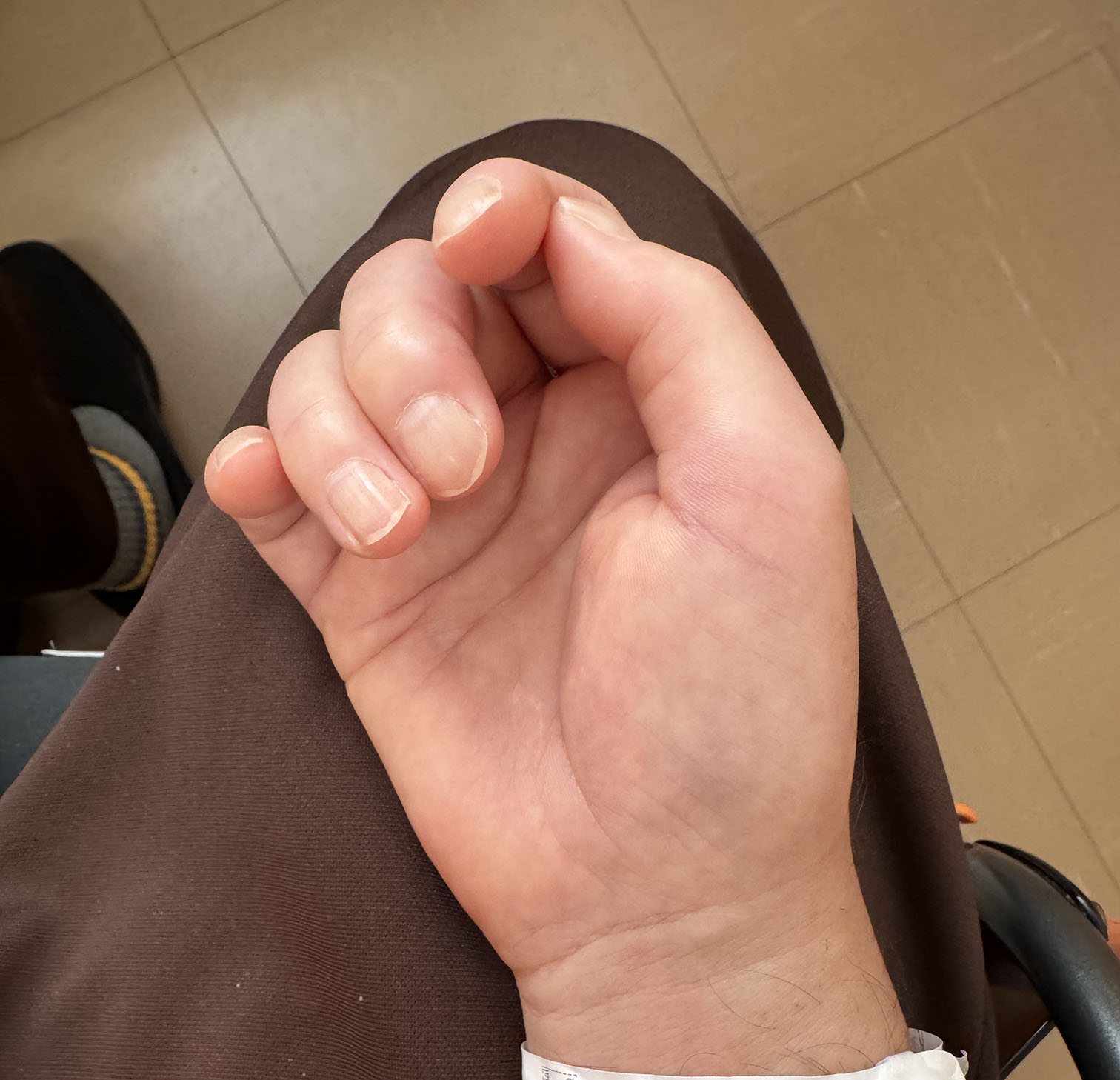 脳梗塞のリハビリ中に、右手の小指がわずかに動いた時